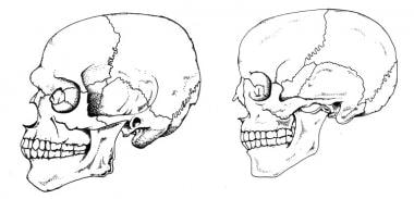 Lateral views of male (left) and female skulls (ri