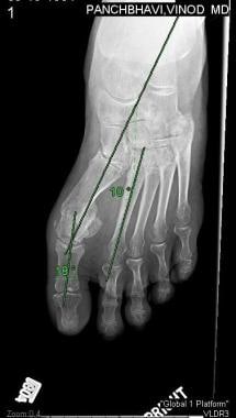 Hallux Valgus Osteotomy Technique: Approach Considerations, Chevron ...