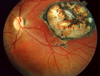 toxoplasmosis retina