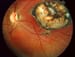 Ocular Toxoplasmosis
