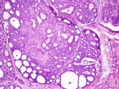 Intraductalis papilloma ductalis hyperplasia Apokrin cystadenoma daganata