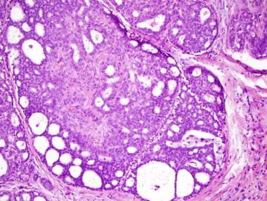 intraductal papilloma with focal atypical ductal hyperplasia)