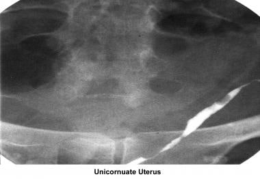 Infertility. Unicornuate uterus. Image courtesy of