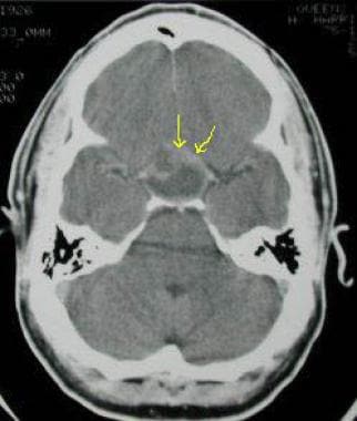 CT scan in a 39-year-old man (same patient as in t