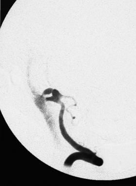 An angiogram showing the onset of an aneurysmal ru