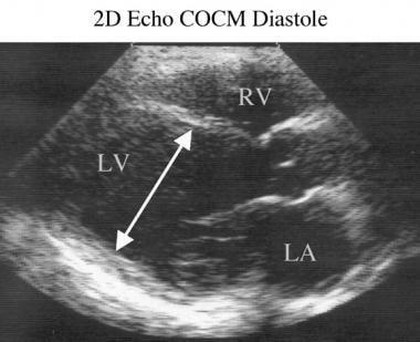 Two-dimensional end-diastolic echocardiogram in a 