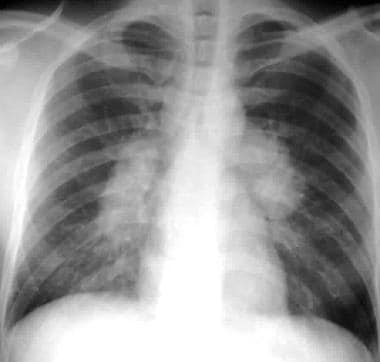 Sarcoidosis, thoracic. Stage I disease. Standard p