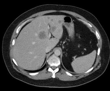 Contrast-enhanced CT showing liver metastases. Sev