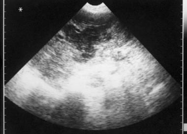 Sonogram of the liver in a 62-year-old woman with 