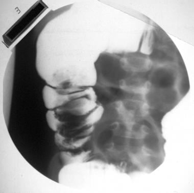 Part of a barium enema study in a 2-year-old child