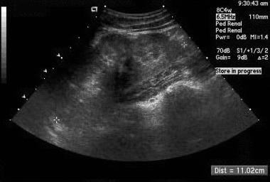 Sonogram in a child with recurrent urinary tract i