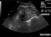 Reflux Nephropathy Imaging: Overview, Radiography, Ultrasonography