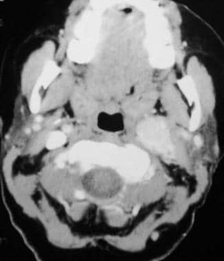Glomus vagale tumor. Contrast-enhanced computed to