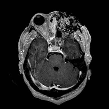 MRI (1.5-Tesla) of the same patient (56-year-old w