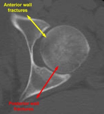 Acetabular fracture orientation with a computed to