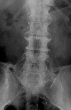 Radiograph of the lumbosacral spine (anteroposteri