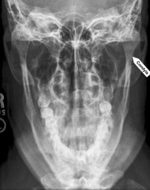 The normal Towne view in this radiograph shows the