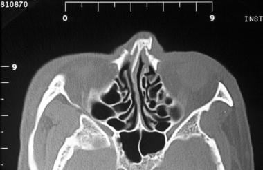 Nasal fracture. Axial CT scan shows a nasal fractu