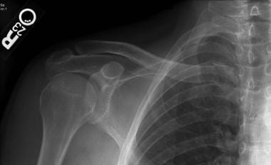 normal clavicle xray