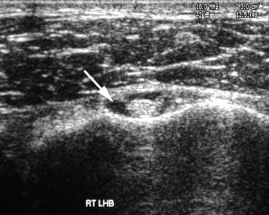 Shoulder, rotator cuff injury (ultrasonography). U