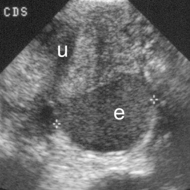 Sagittal view shows an endometrioma (e) in the cul