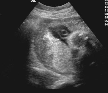 Sagittal endovaginal gray-scale scan in a 21-year-