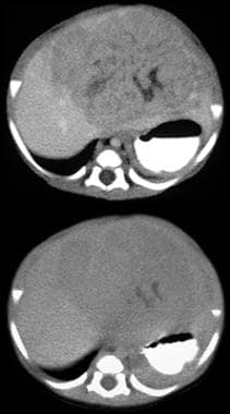 Immediate (top) and delayed (bottom) contrast-enha