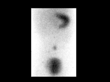 Technetium-99m pertechnetate scan in an 8 year-old