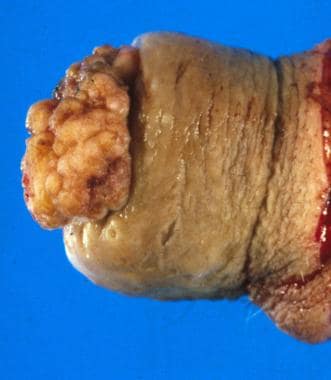 Squamous cell carcinoma of the penis: This case ob
