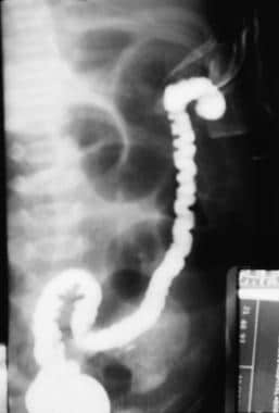 Contrast study of colonic atresia. 