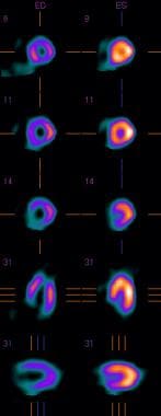 Normal wall motion with radionuclide uptake. 