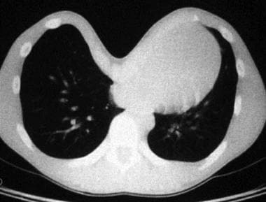 Noncontrast chest CT scan of patient with pectus e
