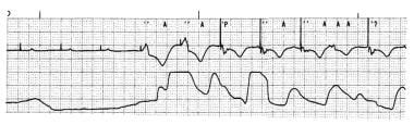 Transcutaneous Cardiac Pacing Technique: Transcutaneous Pacing