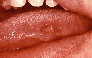 Lesion on the lateral surface of the tongue. Court