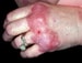 Hypersensitivity Vasculitis