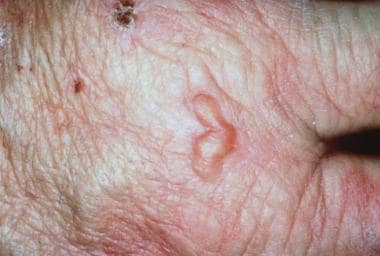 Close-up image of blisters, scarring, and milia. C