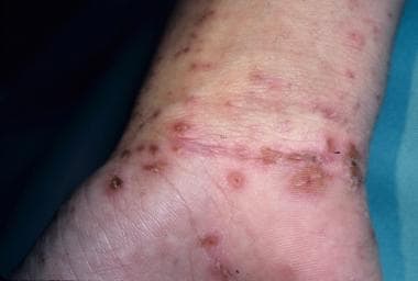 Erythematous papules and papulovesicles on the fle