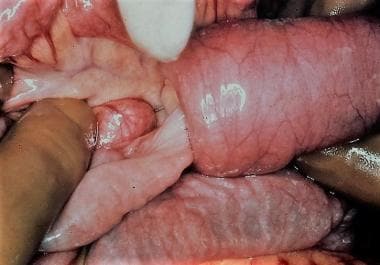 Intestinal obstruction in the newborn. Operative p