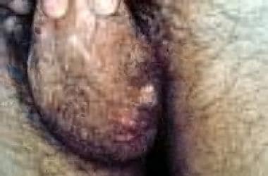 A characteristic genital ulcer on scrotum. 