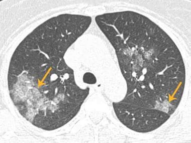 COVID-19 axial chest CT shows bilateral patchy gro