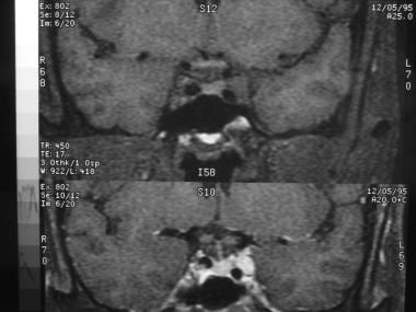 Coronal T1-weighted MRI with (below) and without (