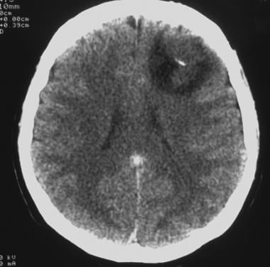 Computed tomography scan of a low-grade oligodendr