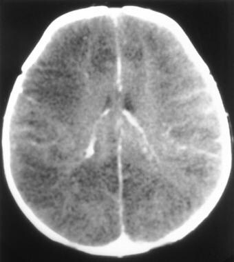 Diffuse cerebral infarcts and edema associated wit
