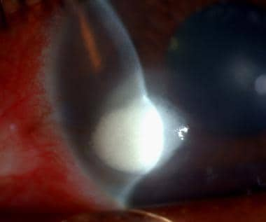 Fungal Keratitis Clinical Presentation: History, Physical, Causes