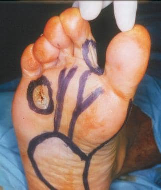 Intraoperative markings for the proposed pedicled 