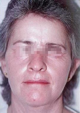 Same patient as in image above underwent combined 
