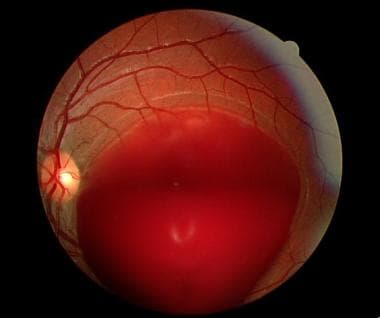 Initial presentation of a Valsalva retinopathy les