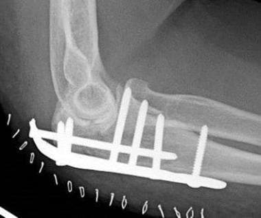 Comminuted olecranon fracture plated with proximal
