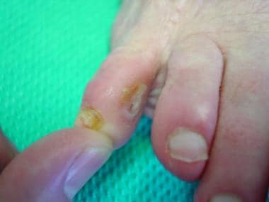 Callus between 4th store and 5th toe