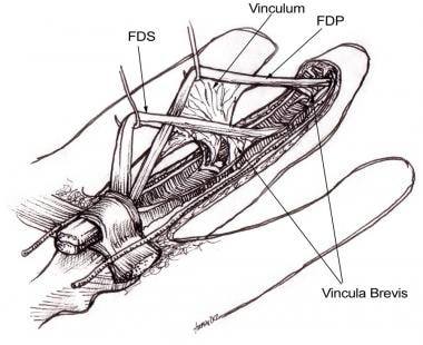 Flexor tendons with attached vincula. FDS, flexor 